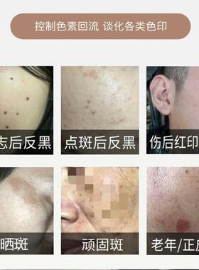 控色霜激光溶膏皮秒术后点斑痣后美容院修覆回流祛黑色素