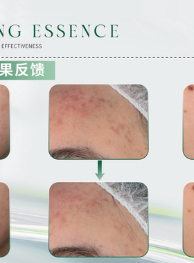 净颜精华液温和控油去痘去黑头