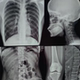 X-ray CT film printing dental viewing film