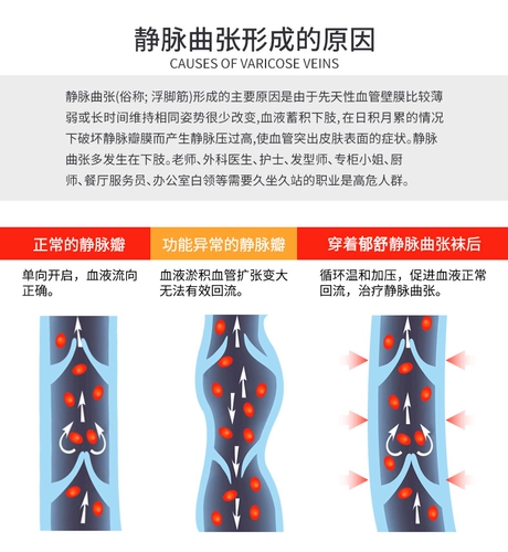 郁舒 Медицинские эластичные носки варикозные вены, эластичные носки, первая вспомогательная терапия, отек, кислота, кислота увеличивает обезболивающую хирургию