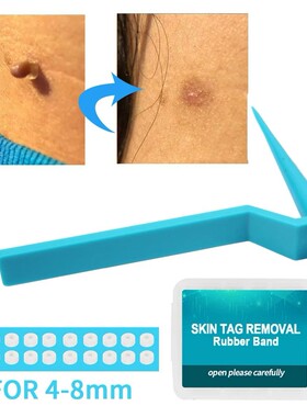 Skin Tag Remover Device for Large Mole Wart Removal with Rem