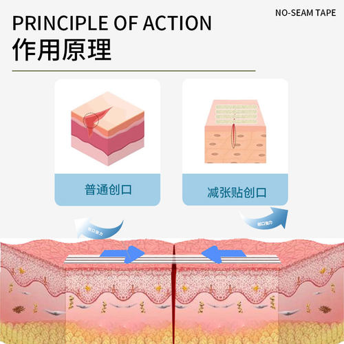 医用免缝胶带减张贴术后伤口免缝合拉合胶布贴儿童皮肤疤痕减张器 - 图0