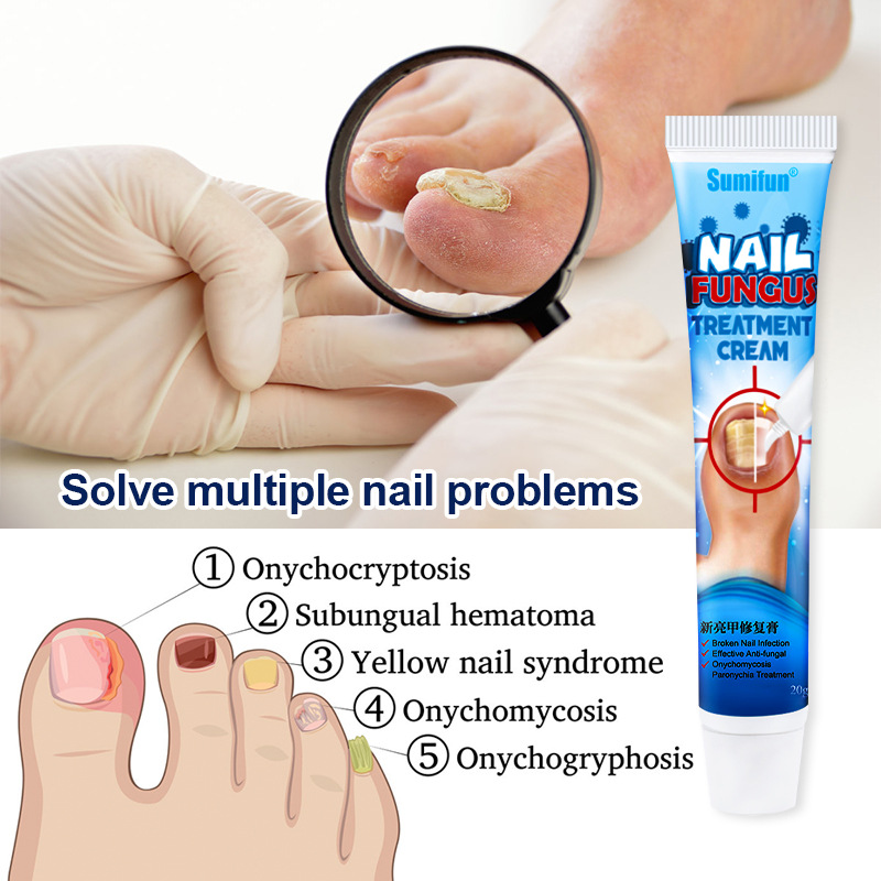 20g Nail Fungus Removal Cream Nail Care Ointment Anti-infect - 图0