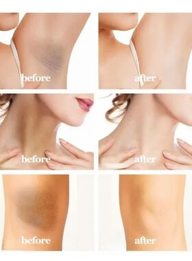 Whitening Cream Quickly Private Parts Dark Skin Underarm Bri