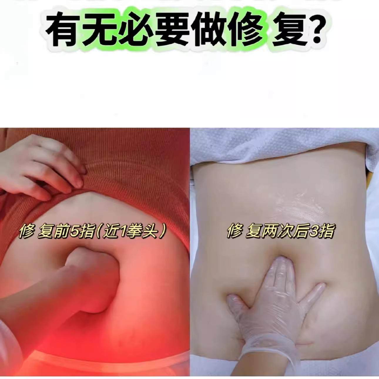 产后收腹训练仪家用腹部直肌锻炼器肚子大松弛分离神器瘦恢修复带,淘宝优惠券,粉丝福利购,淘宝优惠卷