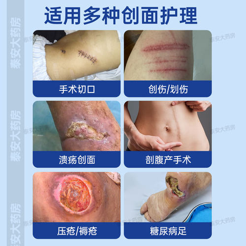 安可信纳米银创伤贴敷料医用银离子伤口抗菌敷料贴专用辅烫伤褥疮 - 图0