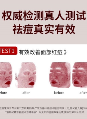 童颜纪精准祛痘点涂精华液温和瘪痘救急去痘控油舒缓敏感肌可用