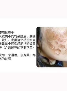 一品莲祛斑液翌芙来正品特号加强精华豆痘黄褐斑雀斑非官方旗舰店