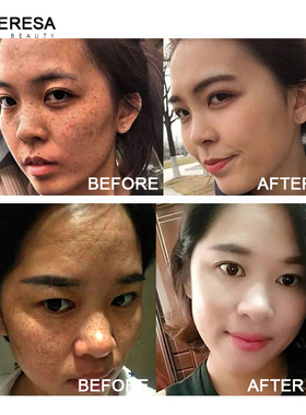 Dark Spot Corrector Whitening Serum Face Bleaching Serum Bri