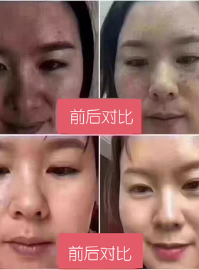 中药面膜粉三件套亮白雀斑黄褐亮控油收缩毛孔淡化色素斑点美容院