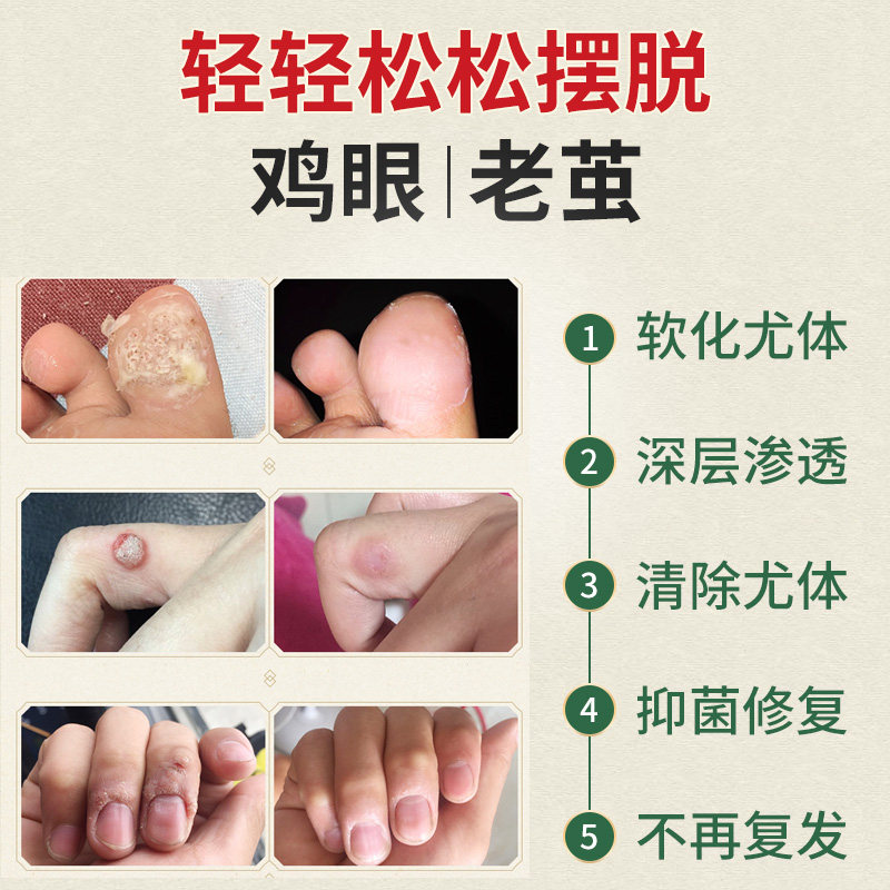跖疣和刺瘊子区别图片,跖疣的区别图图片,跖疣是什么样子图片(第8页)_大山谷图库
