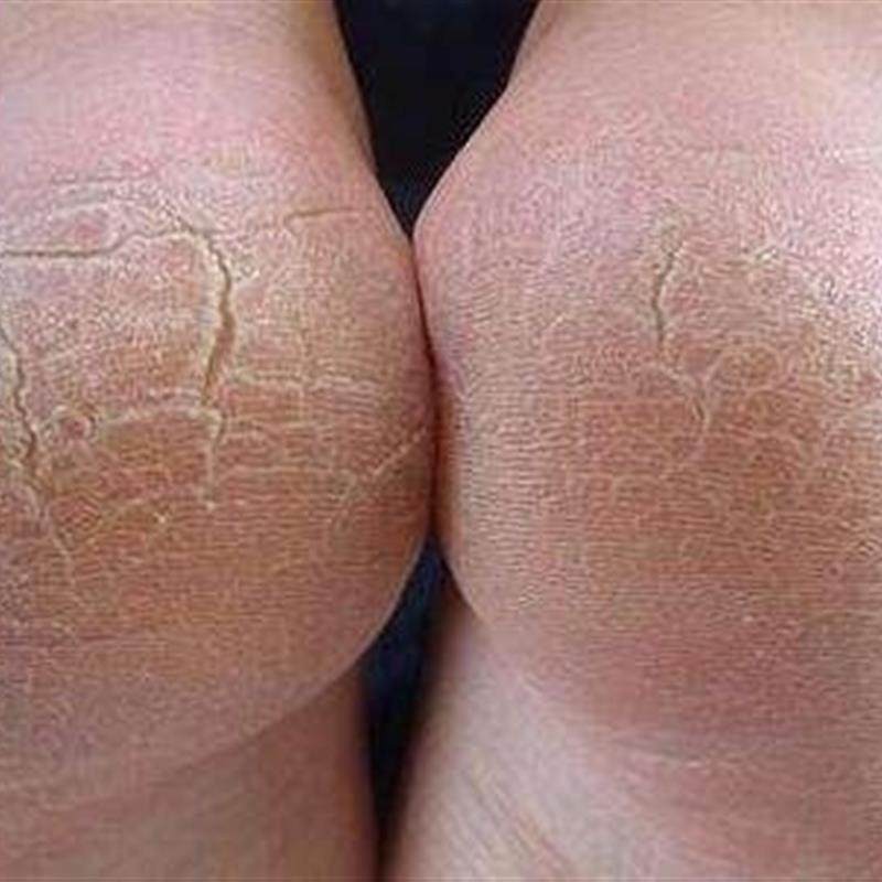 百修福皲裂膏皮肤干燥脚干裂脱皮异味脚痒脱皮脚汽买3送1买5送2,淘宝优惠券,粉丝福利购,淘宝优惠卷