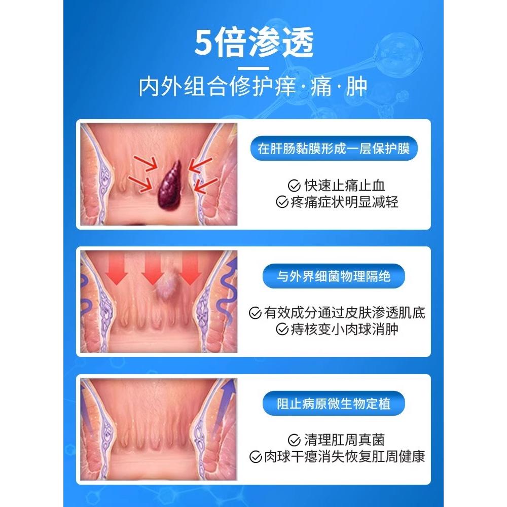 痔疮膏消肉球肛门消痔软膏女性断痔膏卡波姆痣疮冷敷凝胶官方正品