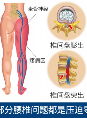突出劳损男女士家用腰托牵引器
