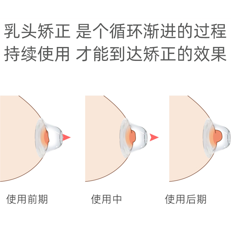 乳头内陷矫正器孕妇少女凹陷奶头牵引器喂奶吸奶头吸引器纠正神器-图1