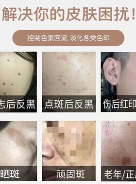 控色霜美容院皮秒激光色素提取点祛斑痘疤痣印反黑淡化黑色素回流