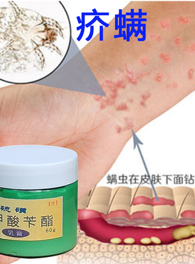 苯甲酸苄酯乳剂硫磺苄硝膏 疥螨 蠕形螨 毛nong焱 酒zha鼻效果佳