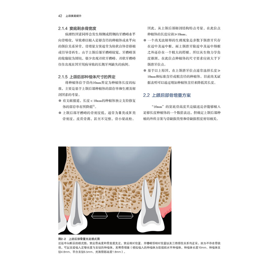 上颌窦底提升 宿玉成 上颌窦解剖鼻窦黏膜种植体负荷方案穿牙槽嵴窦底间隔提升术临床精要书籍上颌窦底骨增量 9787559127464 - 图3