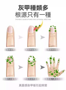 正品美国专研智能灰趾甲光疗机杀真[菌]灯美甲灯灰趾激光机仪器