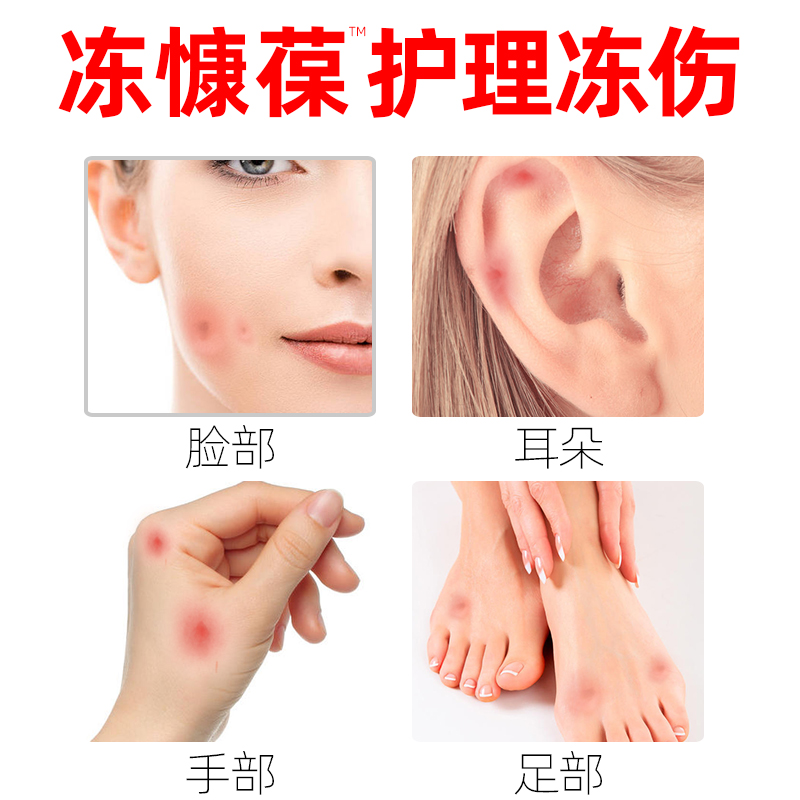 脚医生冻疮膏止痒冻伤膏防冻防裂正品消肿护手霜儿童耳朵冻手冻脚
