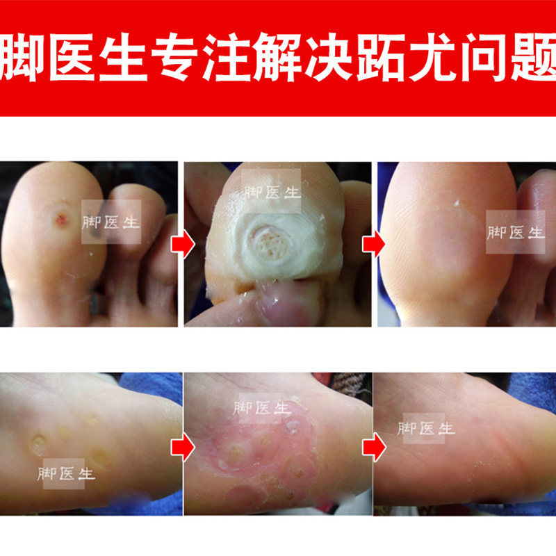 ??脚医生跖疣膏去除足部日本去疣灵 脚医生家居针灸器具（器械）