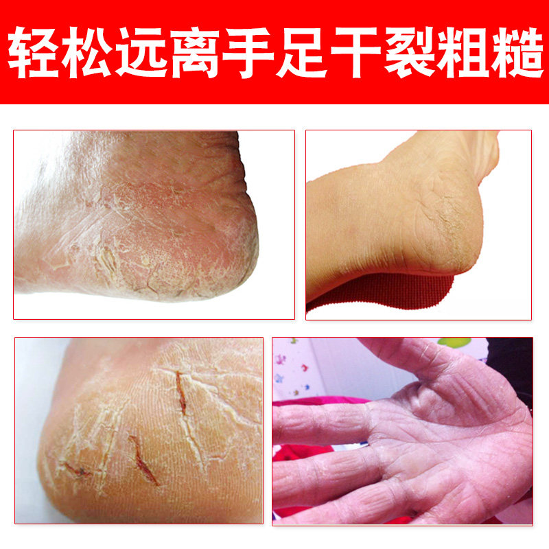 脚医生脚后跟干裂止痒护手霜冻疮膏 脚医生家居护手霜