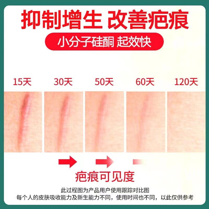  希欢医疗器械祛疤产品