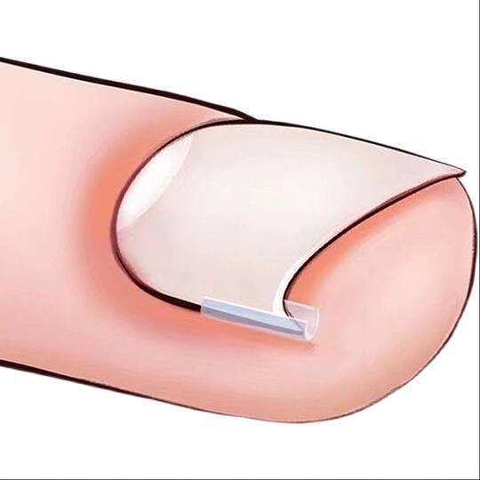 Ingrown toenail correction pad | Over 6,000 additional purchases