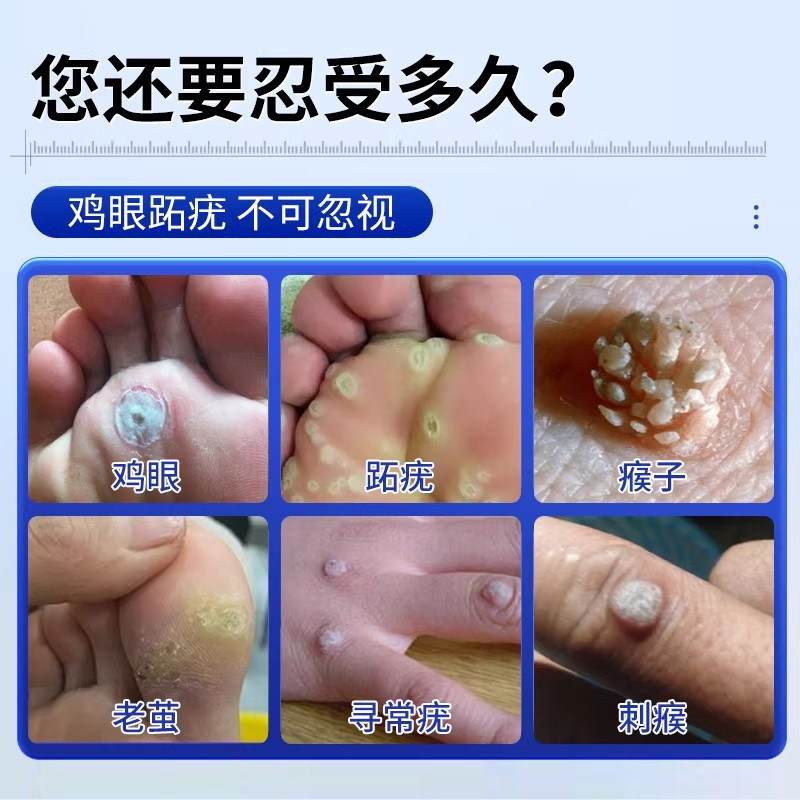 鸡眼贴去除鸡眼膏专用脚底正品旗舰店老茧手上肉刺脚上足无痛根,淘宝优惠券,粉丝福利购,淘宝优惠卷