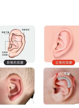 耳朵矫正器婴儿耳廓定型硅胶