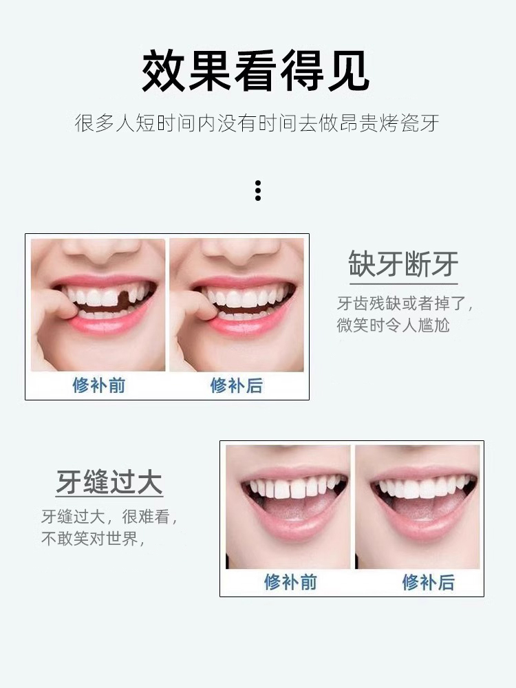 补牙齿洞膏补牙缝修复蛀牙自己在家填牙洞填充剂清理神器临时家用-图2