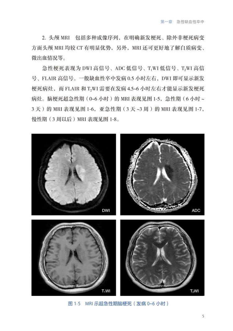 现货正版 裸背精装 北京天坛医院神经医学临床工作手册 脑血管病 配增值 王硕 赵性泉 缪中荣 人民卫生出版社 9787117355384 - 图3