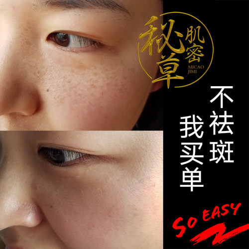 祛斑霜正品套装淡斑祛斑产品快速去斑美白淡化色斑雀斑黄褐斑 - 图0