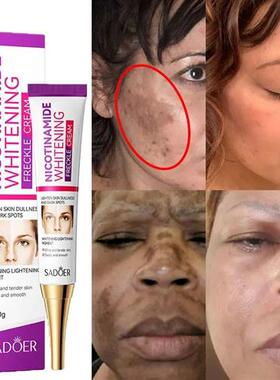 Freckle Removing Cream Repair Pigmentation Nicotinamide Whit