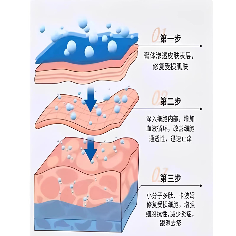 珍珠状丘疹去除冠状沟阴茎珍珠疹粒消炎软膏龟头皮水泡下面XS