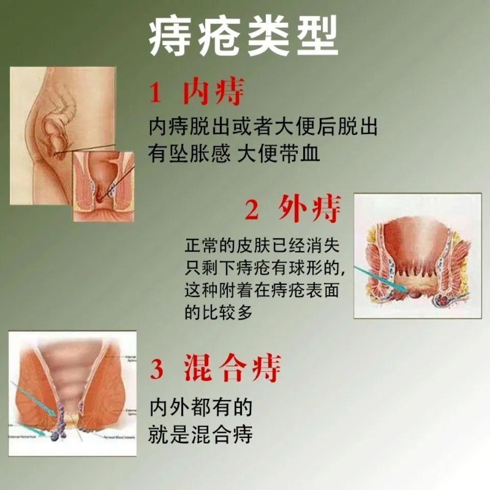 普济太宁栓痔疮膏非根断正品云南白药痔疮栓官方旗舰店特效l药yp6 - 图2