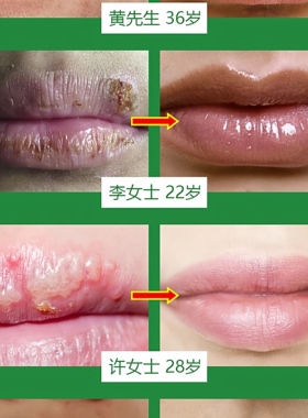 买2送1百约王唇疱康唇部专用唇膏