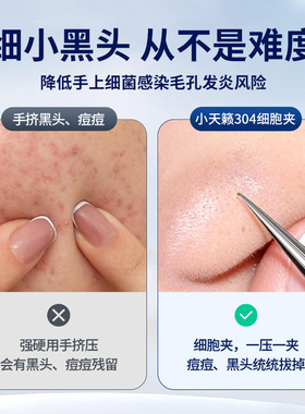 小天籁细胞夹黑头超细医用粉刺针