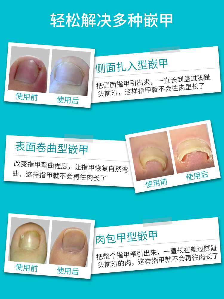 正甲贴甲沟矫正器嵌甲贴片脚趾甲炎拉拉贴矫正神器修脚刀工具套装 - 图2