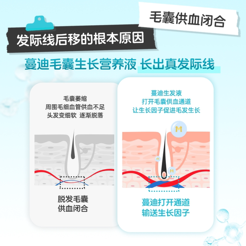 发际线专属蔓迪生发精灵瓶米诺地尔酊上药器男女防脱发增长液精华 - 图0