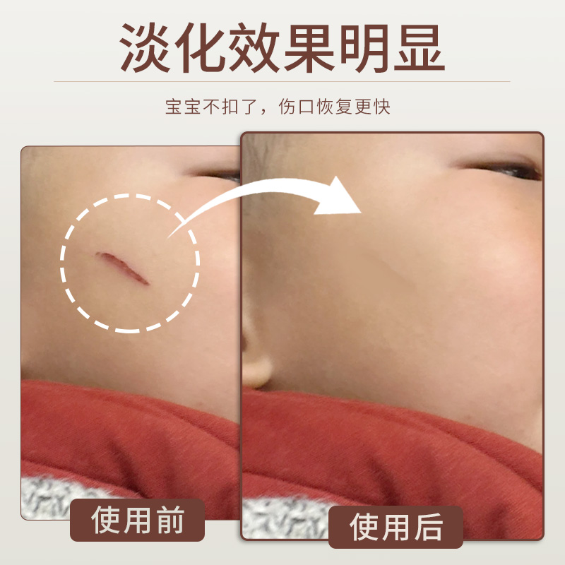 宝宝伤口防抓贴凝胶疤痕贴人工皮贴医用儿童隐形透明止血疫苗防抓 - 图1