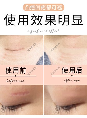 甲状腺疤痕隐形贴手术疤痕遮挡神器凹陷疤痕凸疤填充伤疤隐形