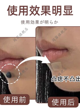遮凸痣贴凹凸疤痕遮盖贴遮瑕贴黑痣脸部凝胶疤痕淡化点痣防水贴