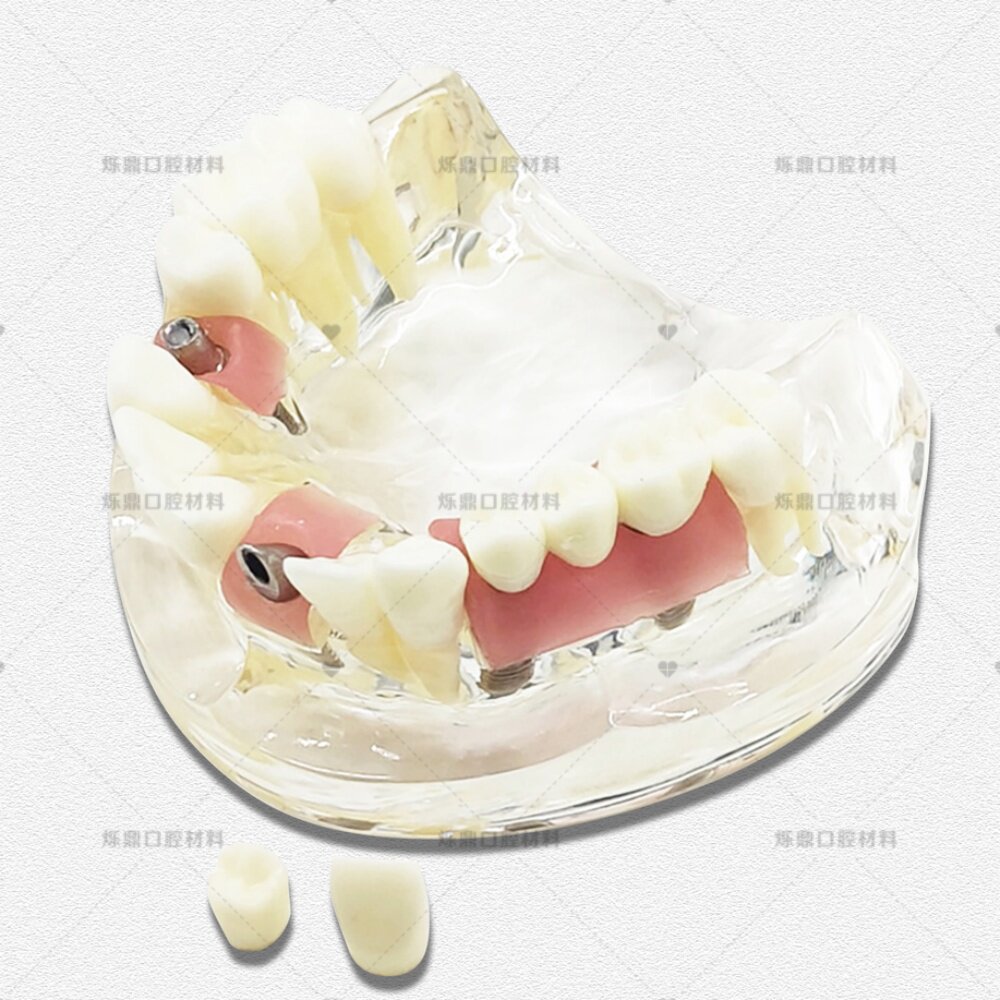 牙科种植演示模型牙齿可拔牙龈拆卸种植钉演示单颗牙齿种植模型