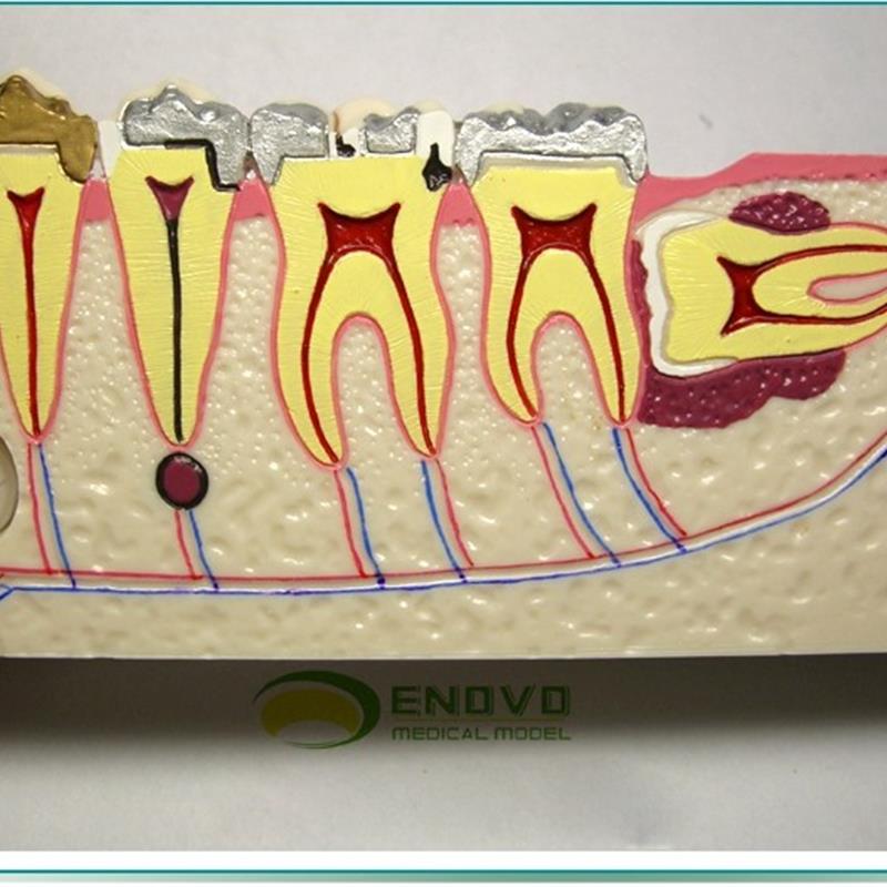 ENOVO颐诺右j下后牙组织分解模型牙齿解剖牙列模型口腔齿科科教学 - 图0
