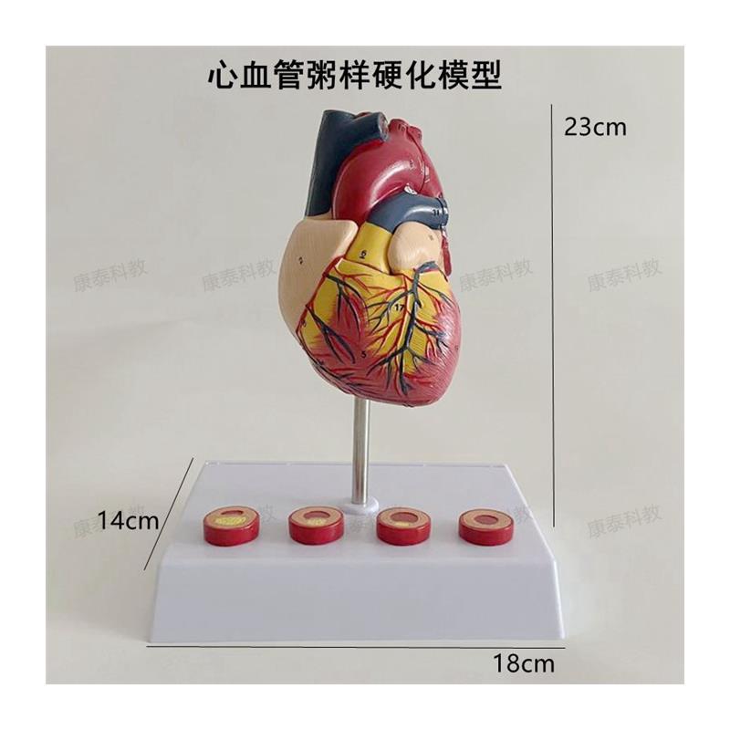 康泰模型a心血管粥样硬化狭窄阻塞病理冠状动脉临床医药促销人体 - 图3