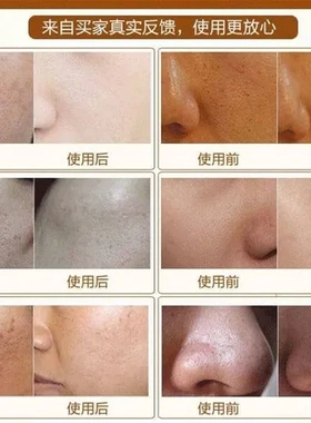 毛孔去黑头按摩膏净化霜收缩毛孔清洁角质清洁霜温和毛囊面部粉刺