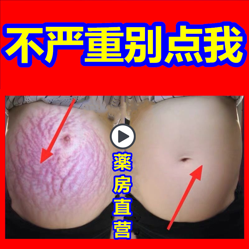 去除妊娠纹神器产后祛壬辰纹精油 纯植物特效微整形精油妊娠纹护理