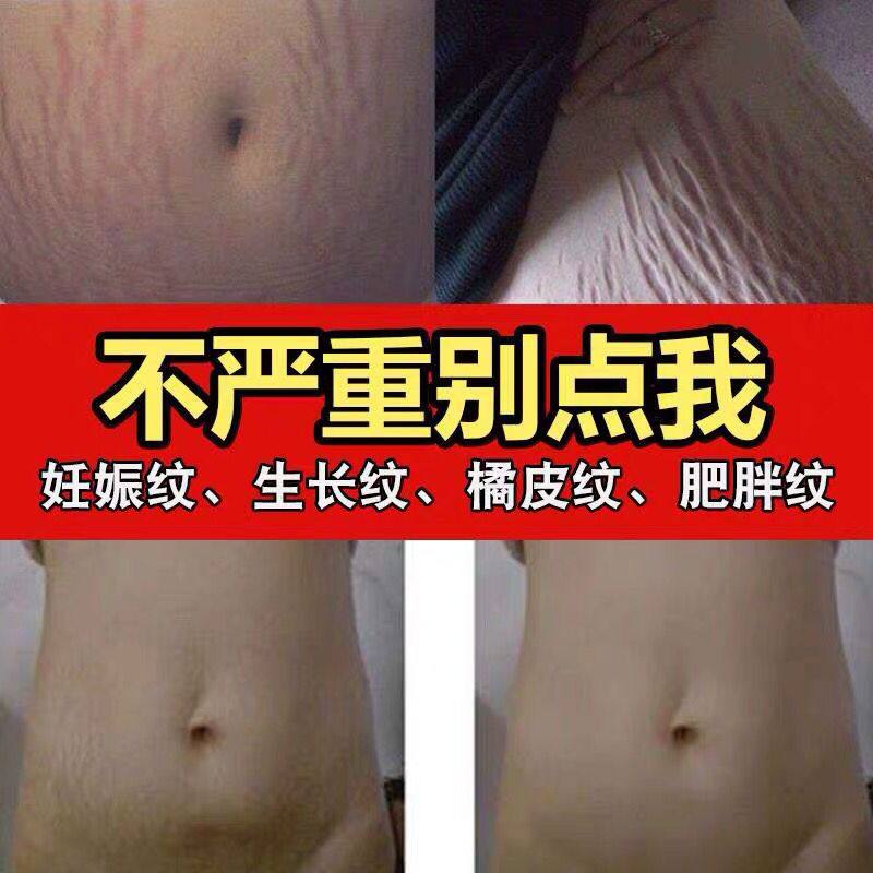 去除妊娠纹神器产后祛壬辰纹精油 纯植物特效微整形精油妊娠纹护理