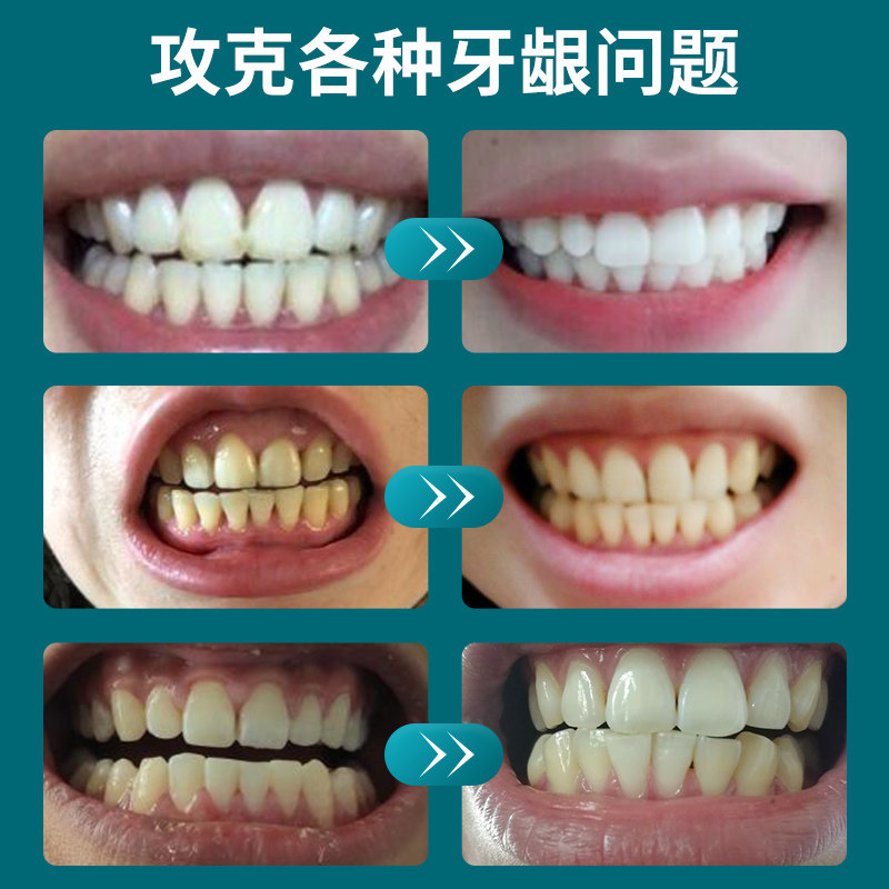 防蛀牙修复牙洞虫牙牙菌斑清理牙膏 力美吉家居牙粉